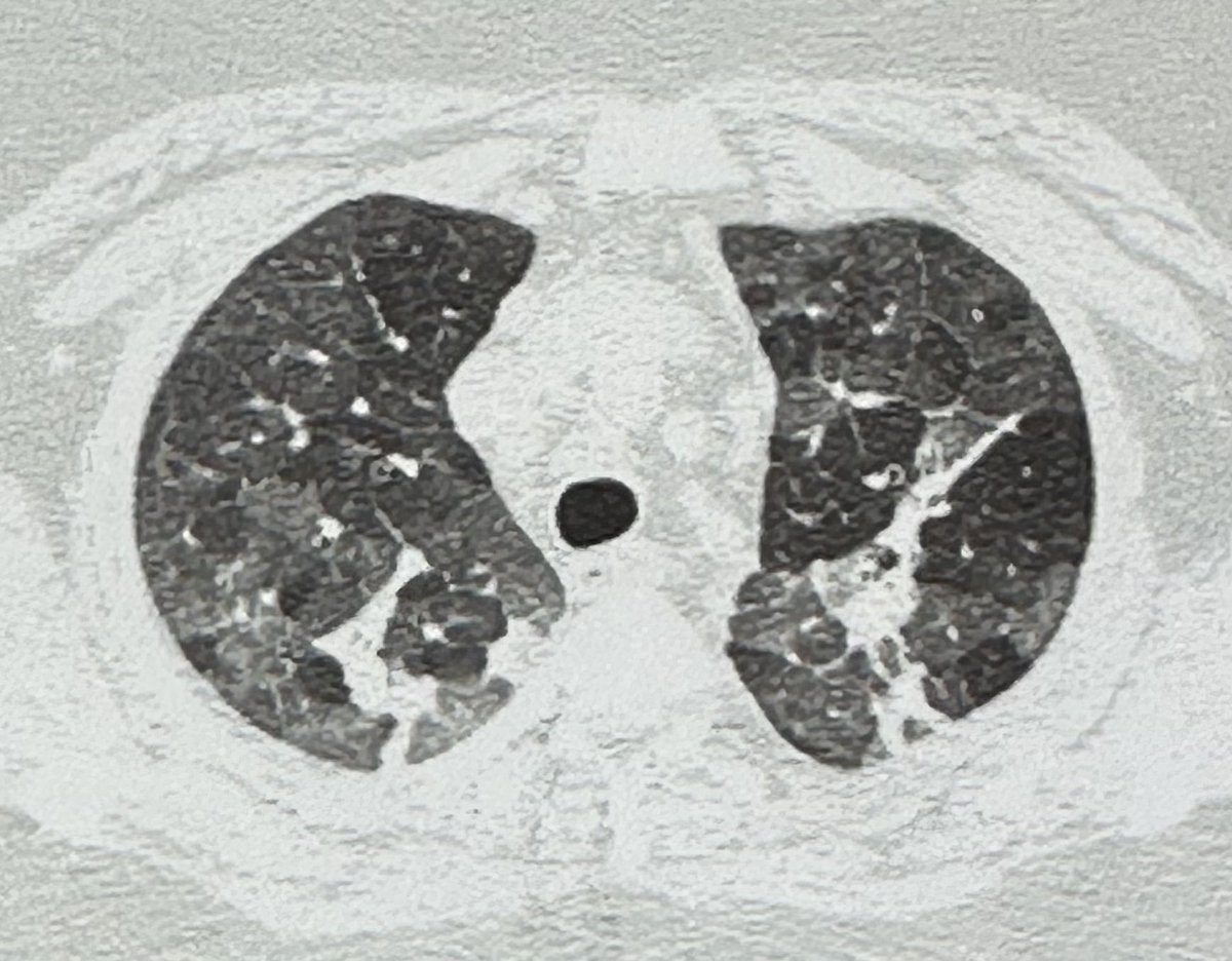 Sivapulmo's tweet photo. #ThreedensitySign (previously called as Head-cheese sign)specific for Typical fibrotic #HypersensitivityPneumonitis.
1.GGO -alveolar infiltration 
2-hypoattenuation/mosaic attenuation -small airway obstruction 
3-normal lung
Actually 4th here consolidation #pulmotomogram https://t.co/OQ8BHPtpRd