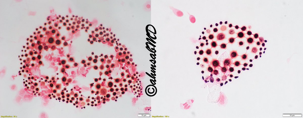 ahmsab_MD's tweet photo. Cryptococcus acting like a textbook beauty on gram stain!!  

#medtwitter #PathTwitter #pathology #Path #path2path #fungi #fungusoftheweek #Microbiology #pathoutpic

@RVivekanandanMD https://t.co/4triNcc6ts
