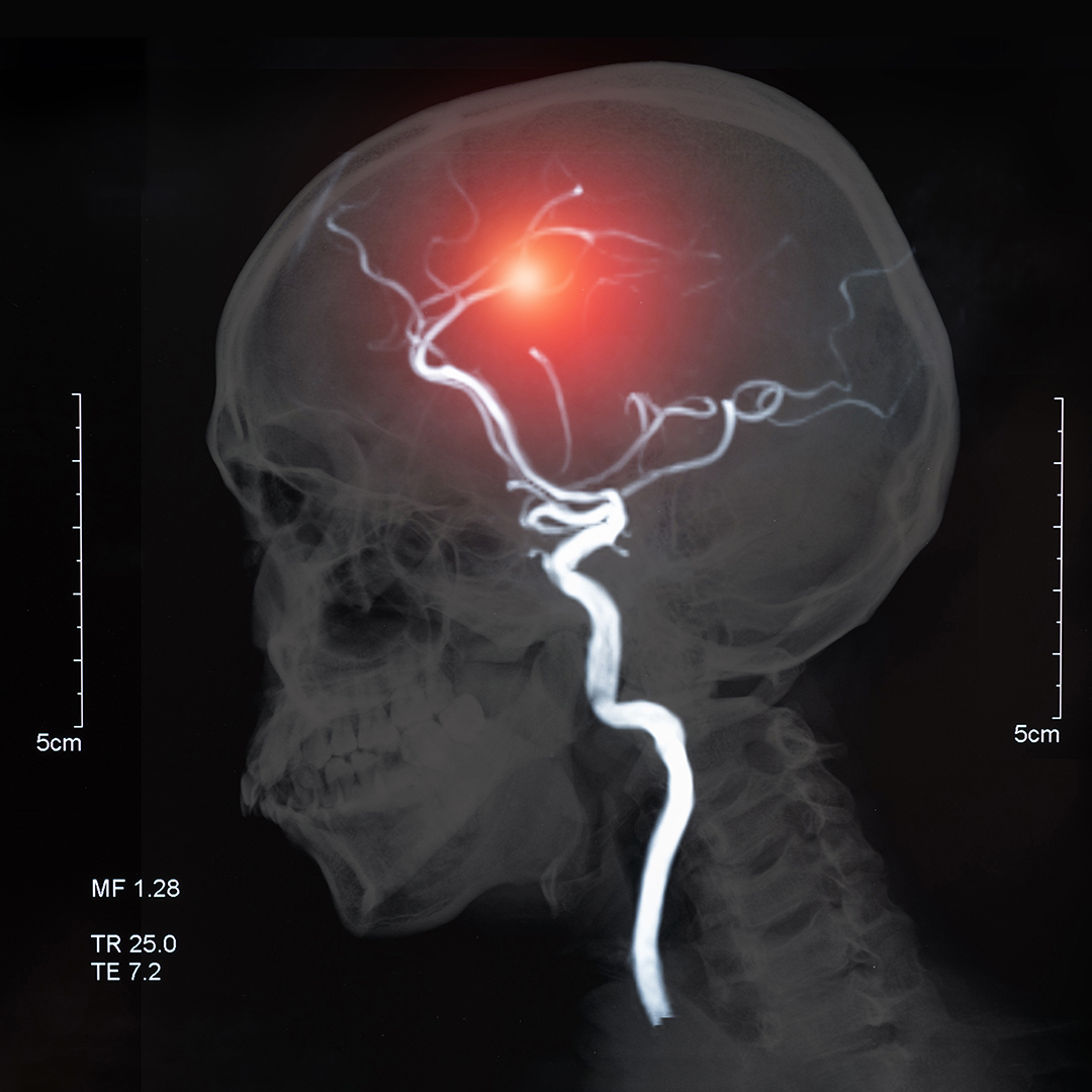 May is National Stroke Awareness Month. Know the signs of a stroke and act F.A.S.T. -- Face drooping, Arm weakness, Speech difficulty, Time to call 911 if someone is having a stroke. You can Spot a Stroke, Stop a Stroke and Save a Life. Learn more at ow.ly/wK7K50OppQQ