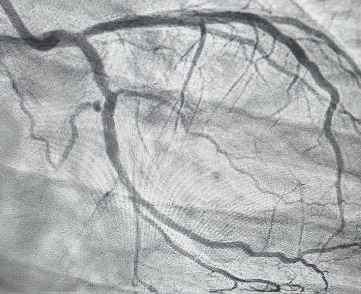 في الأربعين من عمره ليس لديه امراض ولايدخن رجع الى منزله الساعه ٧ مساء بعد دوام طويل ومرهق فحدثت مشاجرة وملاسنة مع زوجته فأصيب بجلطة في القلب وتم فتح الشريان المسدود.

الشاهد:
الانفعال النفسي الشديد من مسببات جلطة القلب...فلاتجلطي قلبَ زوجكِ بلسانكِ.