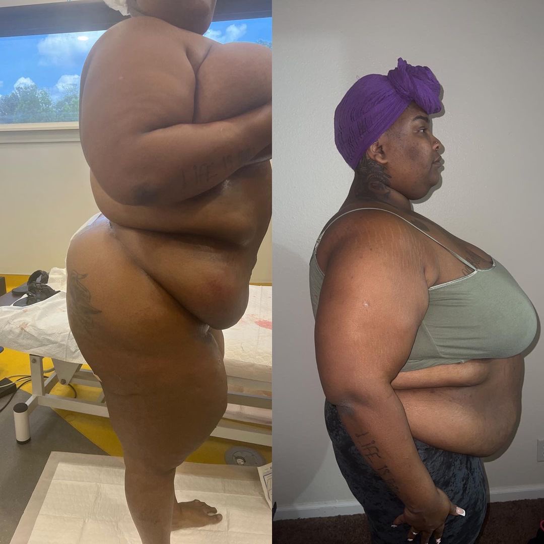 The_ZeusNetwork's tweet photo. Ayyeee!! 😜 It’s #TransformationTuesday with @RPSnackMealz!! Sis officially began her transformation journey with @goalsplasticsurgery yesterday and gave us an inside look!! 🤯 We love and applaud her transparency and bravery through the process!! https://t.co/49hVShgXho