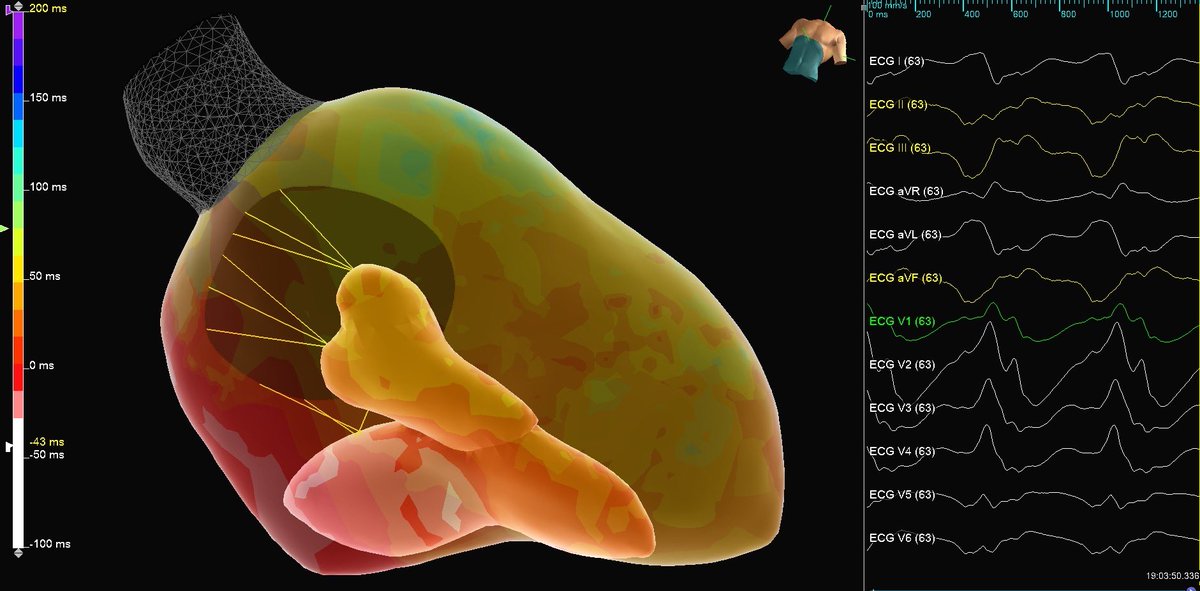 JennyFromTheWB's tweet image. #EPeeps, have you seen a slower VT?

Pt presented with sustained 520ms VT. #HDGrid mapping showed a clear focal origin, and #ViewFlex confirmed catheter contact around our PM pap. CL bumped out to 650ms before breaking on ablation by @_amughal3! 🔥 

@AbbottCardio #AblationNation