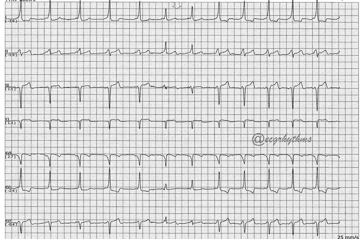 051623

From the📦/📧 by a 🫂
#ECGChallenge
Difficulty level (out of 5⭐️): ⭐️⭐️⭐️

What is your  ECG dx? Poll next

#MedEd 
#MedTwitter 
#CardioTwitter 
#EPeeps