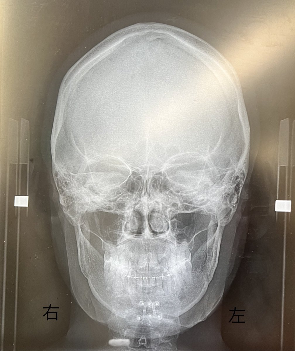 執刀医の診察
顎の左右の歪みについて、
まだ腫れてるからなんともだけど、骨の形は綺麗だし、そんなに心配することない
なんなら顎が長い右側の方が、骨だけ見ると短くなってるくらいだよーとのこと

不安は残るけど、ここ数日の鬱解消してくれた...😂骨ばっか載せてすみません