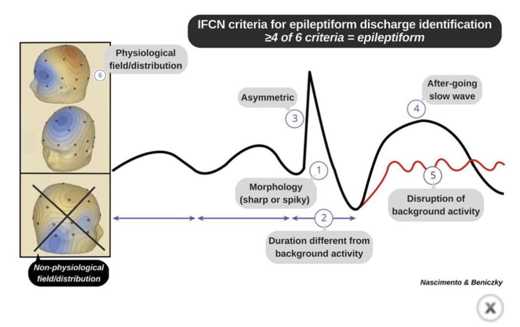 From @greenjournal #NeurologyEd Teaching the 6 Criteria of the International Federation of Clinical Neurophysiology for Defining Interictal Epileptiform Discharges on EEG Using a Visual Graphic ne.neurology.org/content/2/2/e2…