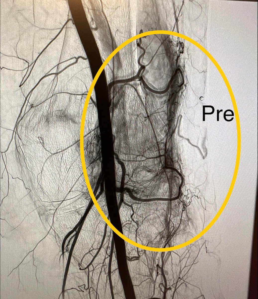 ArizonaVIR's tweet photo. Is pedal access the new radial access?!

We're performing more cases with pedal access with great results &amp; patient satisfaction. Specifically, we're using pedal access for GAEs for the management of OA &amp; hemarthrosis.

@HannallahMD @woodhead @shamaryoungmd

#pedal #SIR #GAE https://t.co/mest3No7vb