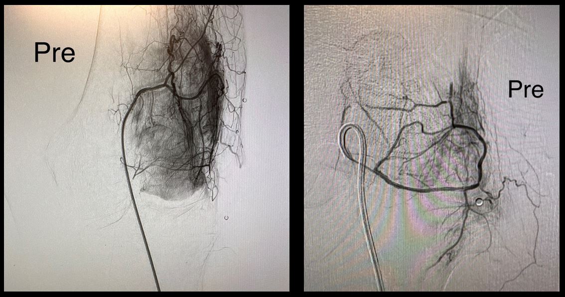 ArizonaVIR's tweet photo. Is pedal access the new radial access?!

We're performing more cases with pedal access with great results &amp; patient satisfaction. Specifically, we're using pedal access for GAEs for the management of OA &amp; hemarthrosis.

@HannallahMD @woodhead @shamaryoungmd

#pedal #SIR #GAE https://t.co/mest3No7vb