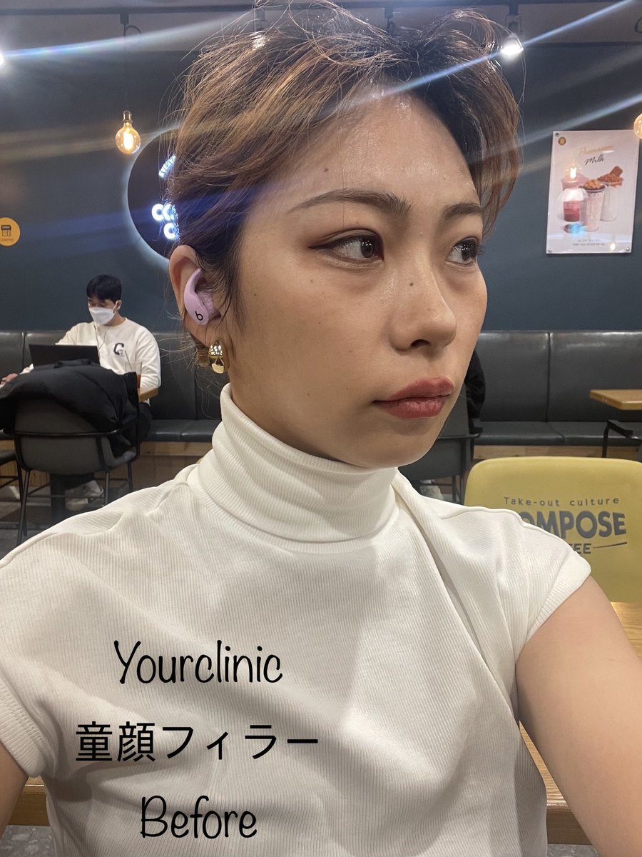 YOURCLINICJP's tweet photo. 13年自信のある童顔フィラー
弘大明洞共通1ccおまかせ9.9万ウォン（部位限定)
#しわボト1箇所3900₩(初回限定)
#リニアZ 100ショト体験価　4.9万₩
プラセンタ注射4.9万₩

リツイートしておくと、5月以降も適用可能 https://t.co/BZrgAl16Sr
