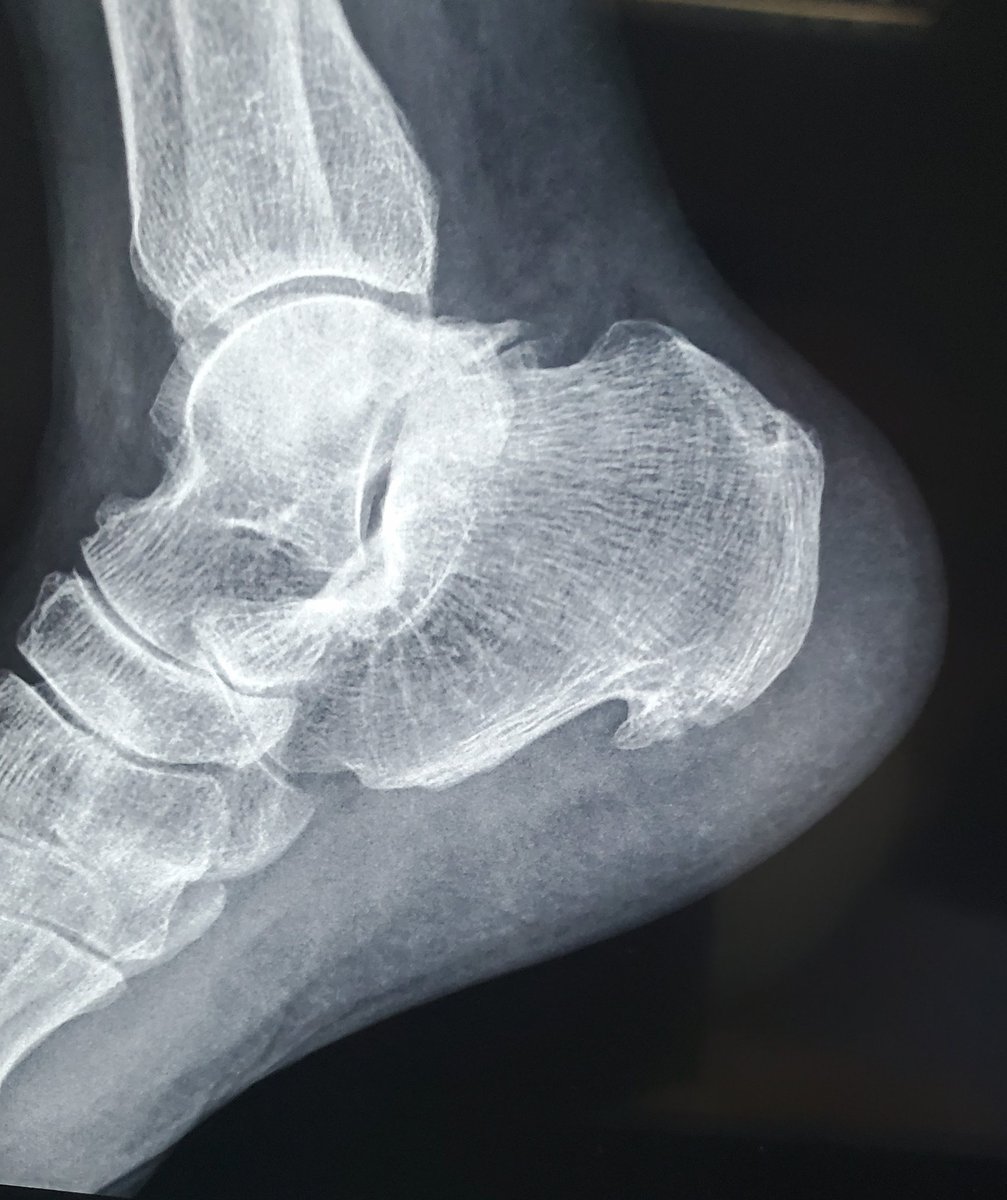 ConsejosReumato's tweet photo. La #talalagia o dolor en talón puede deberse a una fasciitis plantar. La inflamación crónica de la fascia plantar en su inserción en el #calcáneo lleva a una calificación del tejido formándose una excrecencia ósea, el espolón calcáneo. #heel #talón #entesitis #fasciaplantar https://t.co/LWsHXGa0wB