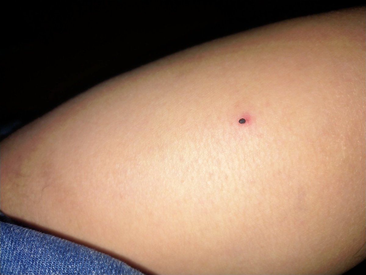 Sayın başkan İstanbul'u bırakıp sağda solda geziyorsunuz piknik alanlarınızı ilaçlaması yapılıyor mu bir kontrol edin 15 Mayıs günü ibb işletmesinde olan piknik alanında bana kene yapıştı.
<a href="/ekrem_imamoglu/">Ekrem İmamoğlu</a> 
<a href="/IBBcozummerkezi/">İBB Çözüm Merkezi</a> 
<a href="/ibbhabercomtr/">İBB Haber</a>