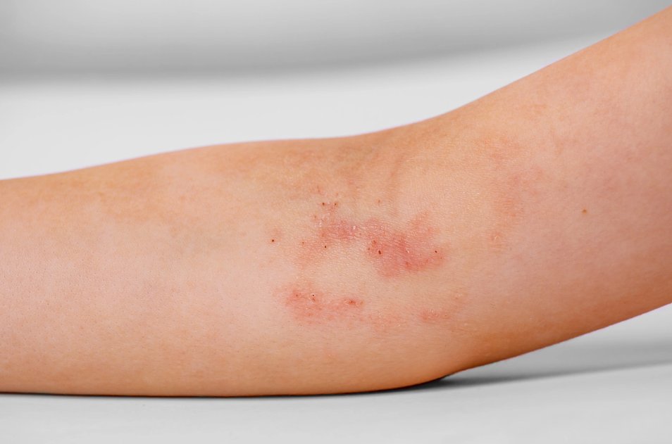 clin_pediatric's tweet photo. Tapinarof cream 1% demonstrated positive topline results in the second of 2 phase 3 studies evaluating safety and efficacy while treating moderate to severe atopic dermatitis in patients 2 years and older. 
 #pediatriccare #pediatricresearch #atopicdermatitis #tapinarof #research https://t.co/8rcXA5yHuj