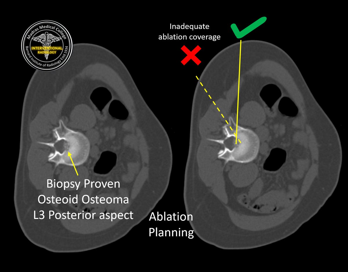 iRadBIR_Chennai's tweet photo. Challenging case of Vertebral #OsteoidOsteoma in L3 body posterosuperior aspect referred for #ablation. Did #Laser ablation (vs RFA🤔) and Epidural air as #ThermalProtection. Satisfying procedure, Excellent #PainRelief 😃 @ISVIRIndia @SIRRFS @cirsesociety #MedTwitter #iRad https://t.co/J6wjYDZbTy