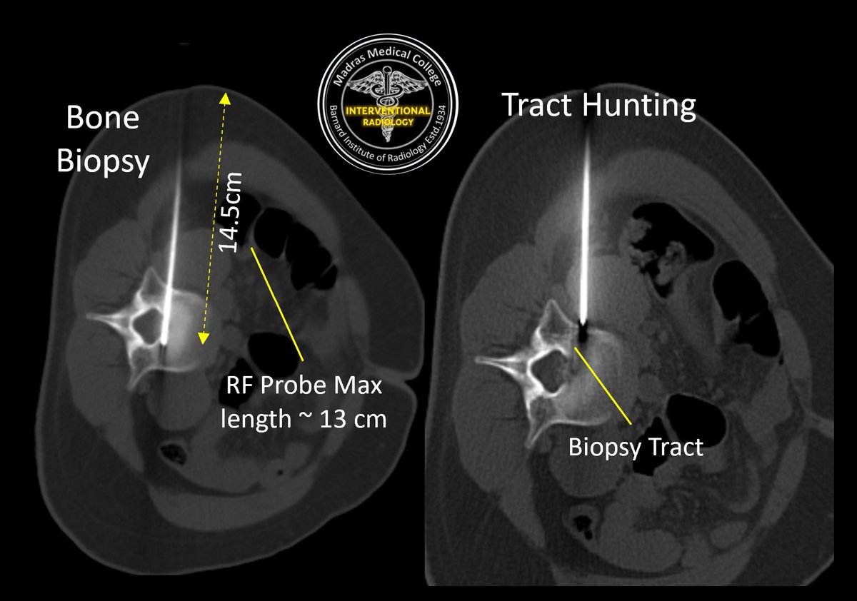 iRadBIR_Chennai's tweet photo. Challenging case of Vertebral #OsteoidOsteoma in L3 body posterosuperior aspect referred for #ablation. Did #Laser ablation (vs RFA🤔) and Epidural air as #ThermalProtection. Satisfying procedure, Excellent #PainRelief 😃 @ISVIRIndia @SIRRFS @cirsesociety #MedTwitter #iRad https://t.co/J6wjYDZbTy