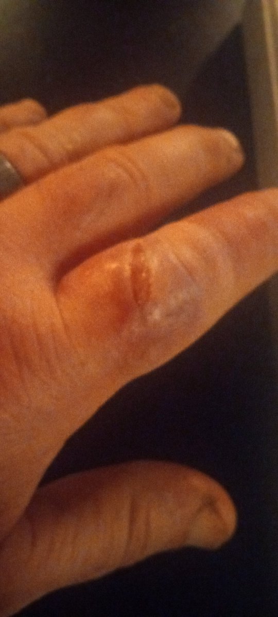 ChefAussie2022's tweet image. Always remember to keep cuts clean. I was foolish and thought this was just a scratch