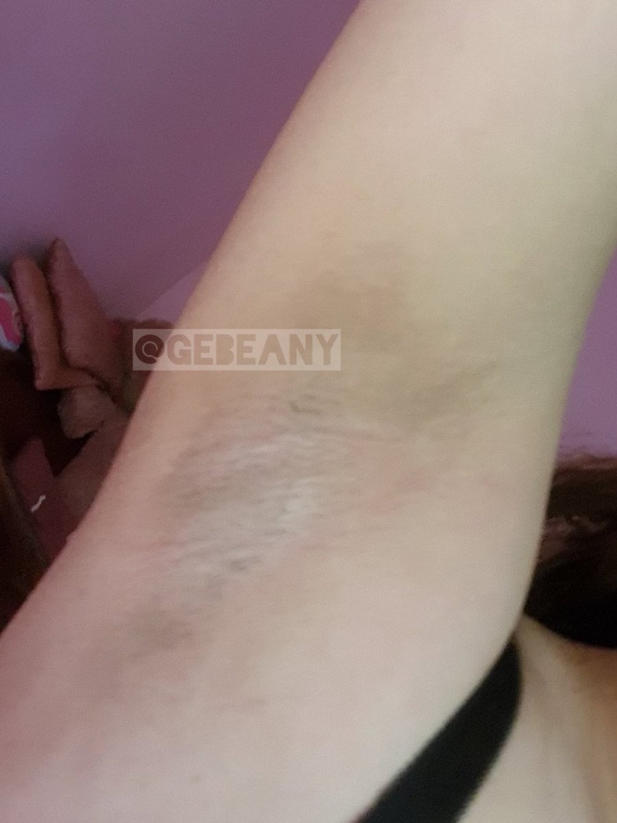 gebeany's tweet photo. before after tmenku yg ak racunin underarm cream 😭 pkainya ngga rutin tpi lumayan bngt hasilnya. minusnya antrian jastipnya pnjang jdi hrs extra sabar 😣 klau hoki biasanya 5 hari lngsung dapet tpi klau lg ramai smpe sebulan antrinya https://t.co/q1ogXN3jqU