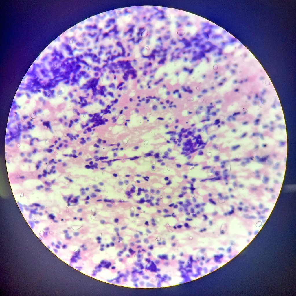 Shruti79688953's tweet image. #wilmstumor #pathologylove #pathtwitter
