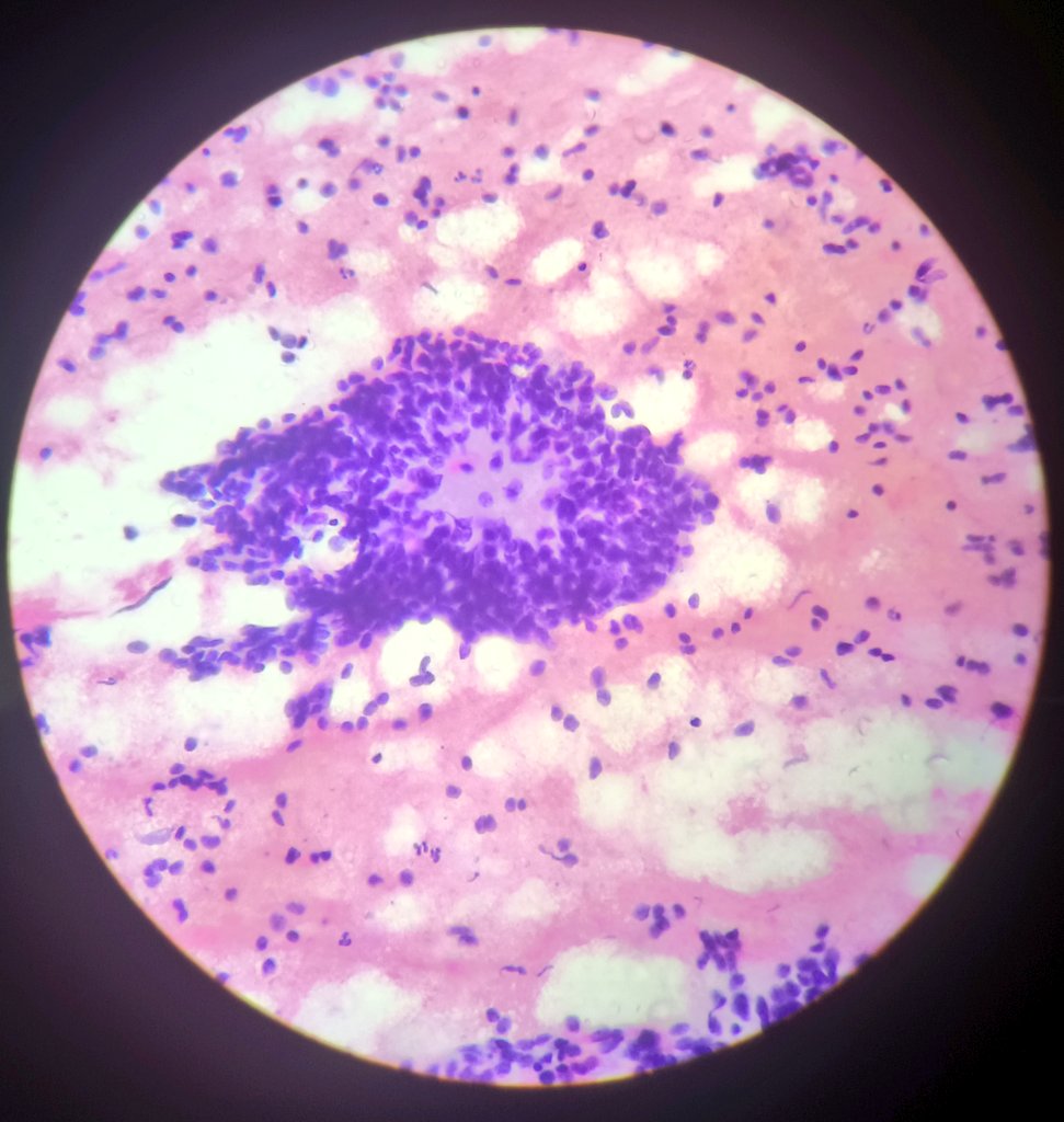 Shruti79688953's tweet image. #wilmstumor #pathologylove #pathtwitter