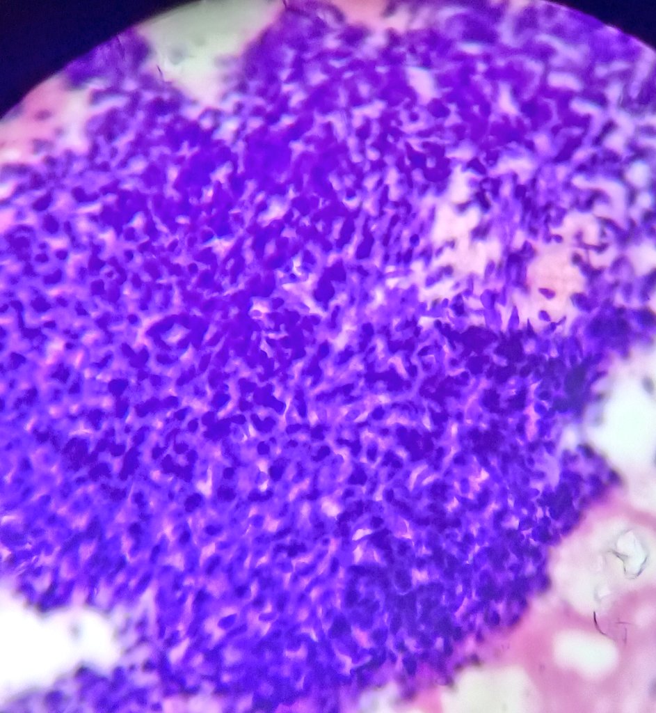 Shruti79688953's tweet image. #wilmstumor #pathologylove #pathtwitter