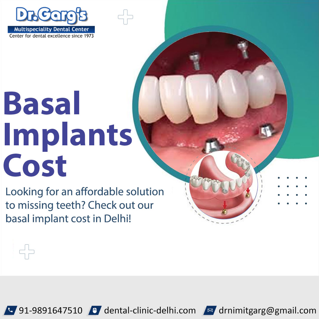 drgargsdental's tweet image. #Basalimplants are the most advanced form of dental implantology. visit Dr. #GargsMultispecialityDentalCenter. 

🌐 dental-clinic-delhi.com/dental-implants
📞 98916 47510 
WhatsApp on: wa.me/919891647510 

#basalimplantsinIndia #basaldentalimplant #tbt #follow #WednesdayFeeling