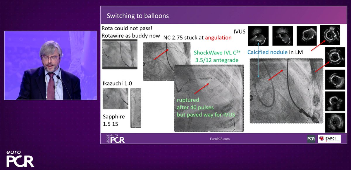 KardiologieHH's tweet image. @ShockwaveIVL Session at #EuroPCR
Amazing talk by @stefan_harb: 
➡️More pulses in eccentric and nodular calcium

🔫+🔫= #RotaShock (#ShotTheCalcium)