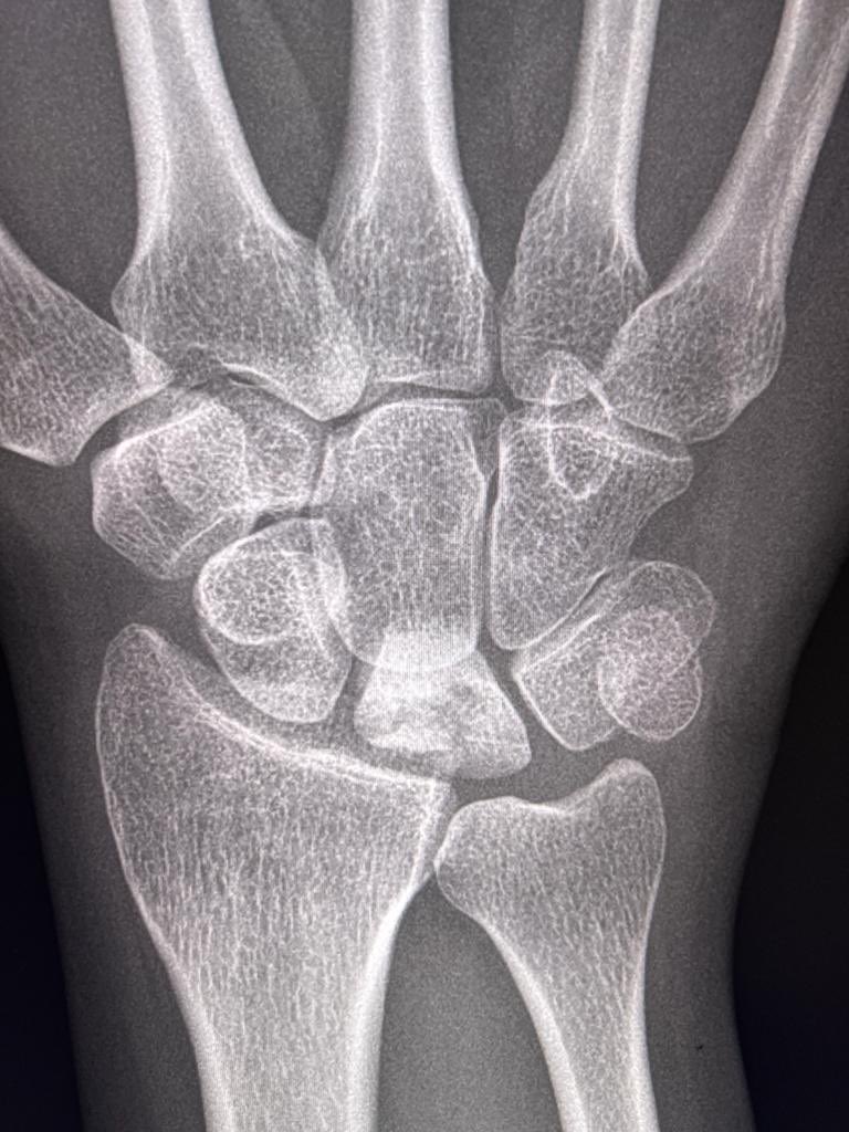 Painful wrist 🤕
What is happening here? 
❤️ & ♻️ 

#mskrad #radiology #FOAMrad #auntminnies #radres