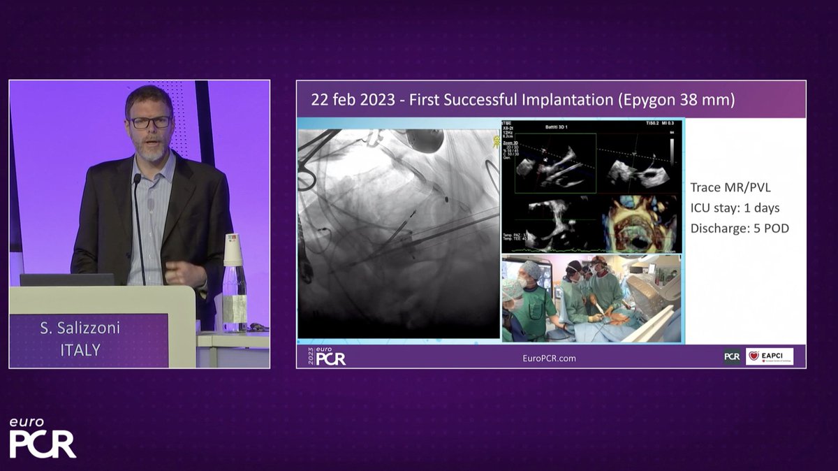 Sticchi_Alex's tweet photo. #Mitral & #Tricuspid #LBT session at #EuroPCR 2023:
Dr Salizzoni @cittasalute_to presented the early experience with a #dshape, #monoleaflet #TA #TMVR system #Epygon!
@PCRonline @sbrugaletta @guilbon @ABeneduceMD
@KardiologieHH @sbrugaletta @kiadeb87
@ANazmiCalik @FabienPraz https://t.co/fOiG1OKIPe