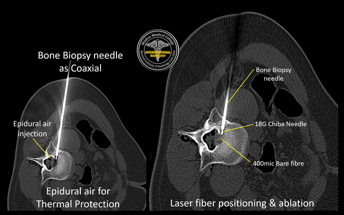 iRadBIR_Chennai's tweet photo. Challenging case of Vertebral #OsteoidOsteoma in L3 body posterosuperior aspect referred for #ablation. Did #Laser ablation (vs RFA🤔) and Epidural air as #ThermalProtection. Satisfying procedure, Excellent #PainRelief 😃 @ISVIRIndia @SIRRFS @cirsesociety #MedTwitter #iRad https://t.co/J6wjYDZbTy