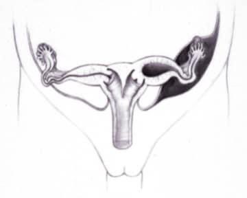 DrsPenaBischoff's tweet photo. Duplicated Mullerian structures (2 hemi-vaginas and 2 hemi-uterii) = higher risk for menstrual obstruction.
60% of cloaca patients have Mullerian duplication.
Most common symptom of menstrual obstruction = cyclic (monthly) abdominal pain. With an US, uterus is filled with blood. https://t.co/GlFrt5PSjj