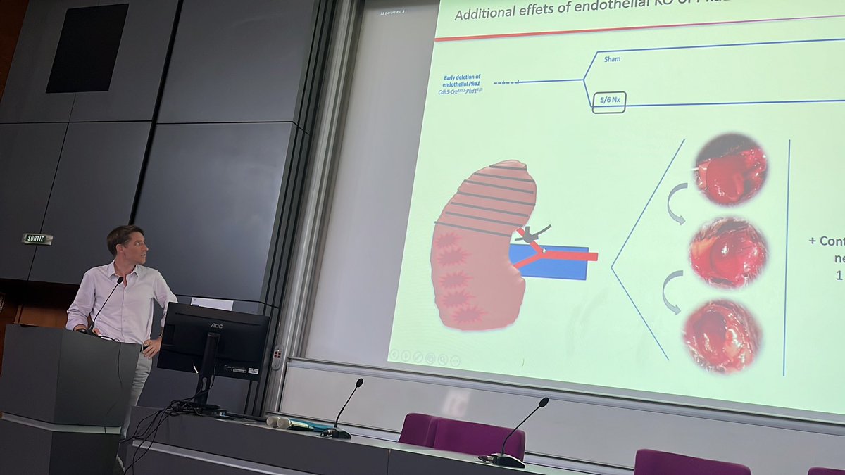 sfhta's tweet photo. Le Pr Dominique Guerrot nous présente son travail sur les causes de l’Hypertension Artérielle chez les patients ayant une polykystose rénale autosomique dominante.
➡️Impact des polycystines sur la fonction endotheliale
#masterclassSFHTA
@dguerrot @CHURouen @univrouen
@com_SFNDT https://t.co/hhjIOvuelY