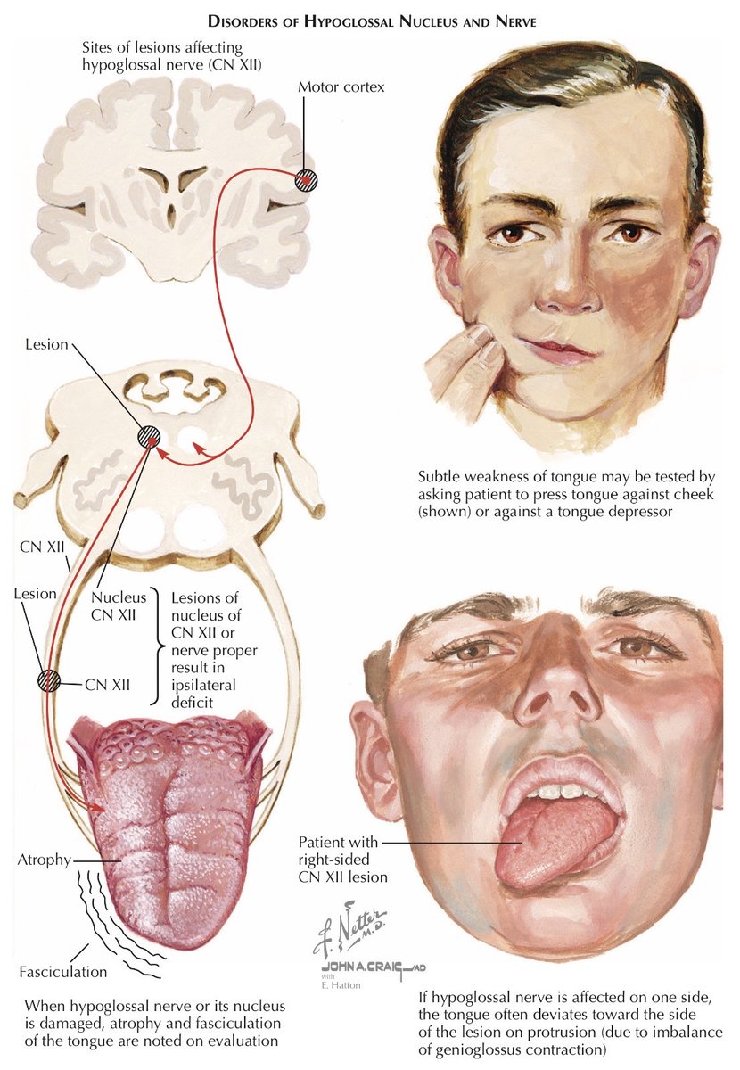 OGdukeneurosurg's tweet photo. Hypoglossal nerve from netter https://t.co/q2ZsN7fojM