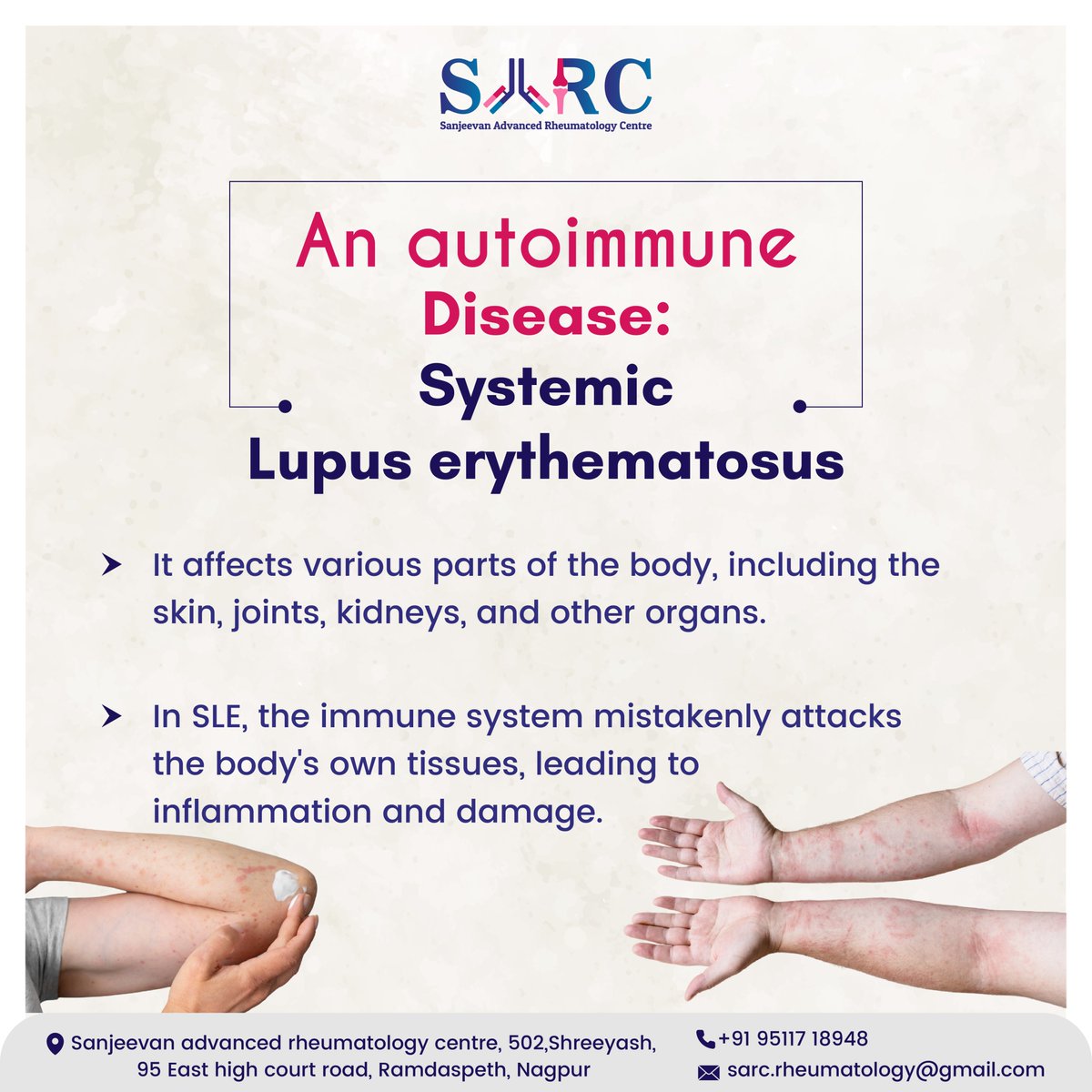 An Autoimmune Disease: Systemic Lupus erythematosus

#LupusAwareness #AutoimmuneDisease #ChronicIllness #LupusFlar #ButYouDontLookSick #LupusWarrior #InvisibleIllness #SLE #LupusSupport #LupusCommunity