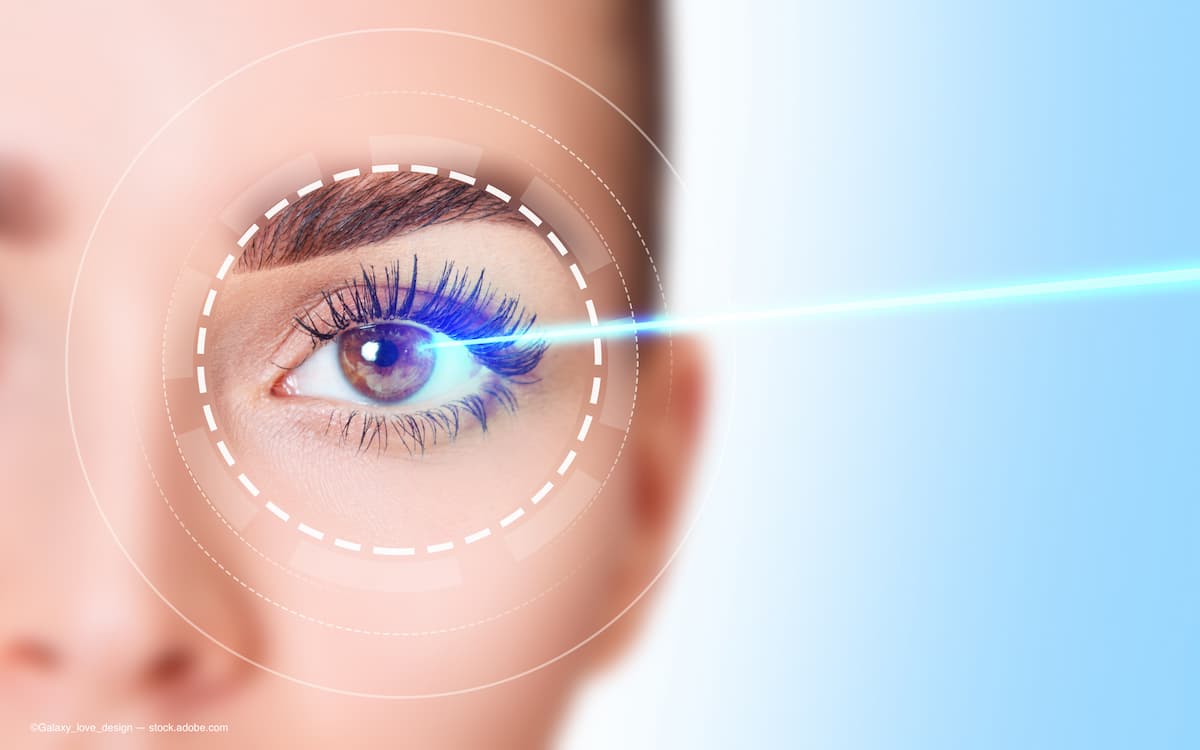 OphthTimes's tweet photo. Laser trabeculoplasty is the workhorse in open-angle glaucoma, and can be used to treat patients with various stages of glaucoma. Interestingly, however, the best way to apply it to the glaucoma treatment algorithm is still debated.

Read More: https://t.co/VtB4O5IVy1 https://t.co/9PUS5SvX68