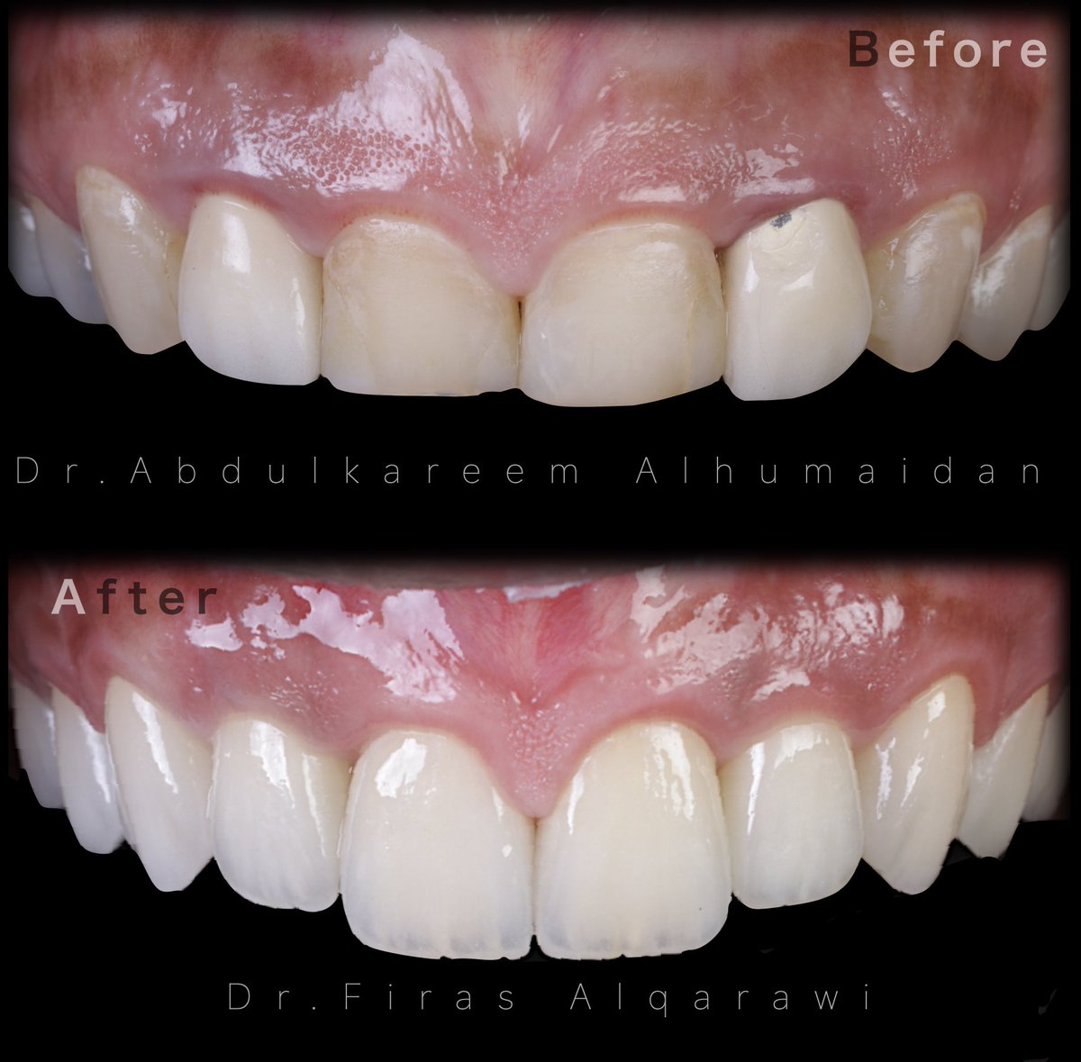 حالة مع استشاري الزراعة و اللثة المتميز <a href="/Draalhumaidan/">Dr.AAAlhumaidan</a> 
.
زراعة و لثة تجميلية و تلبيسات ال"اي-ماكس" 
.
<a href="/dentalhousec/">Dental House Clinics</a> 
.
العمل الجماعي بين التخصصات مفتاح النجاح 
.
#الدمام #الخبر #الرياض #عيادات_الخبر #تجميل_اسنان #ابتسامة_هوليود #اسنان #طب_اسنان #طب_الاسنان