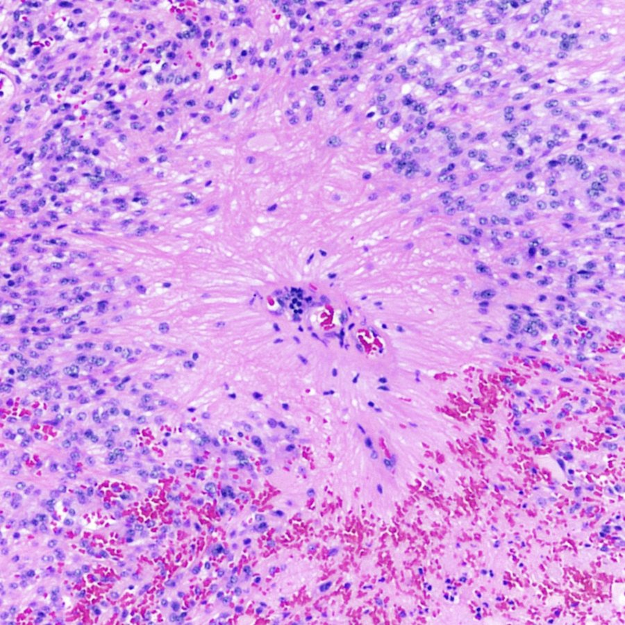 CraigHorbinski's tweet photo. This has got to be the biggest perivascular pseudorosette in a spinal ependymoma I've ever seen. #pathology #neuropath #PathTwitter https://t.co/IOIViwReVc