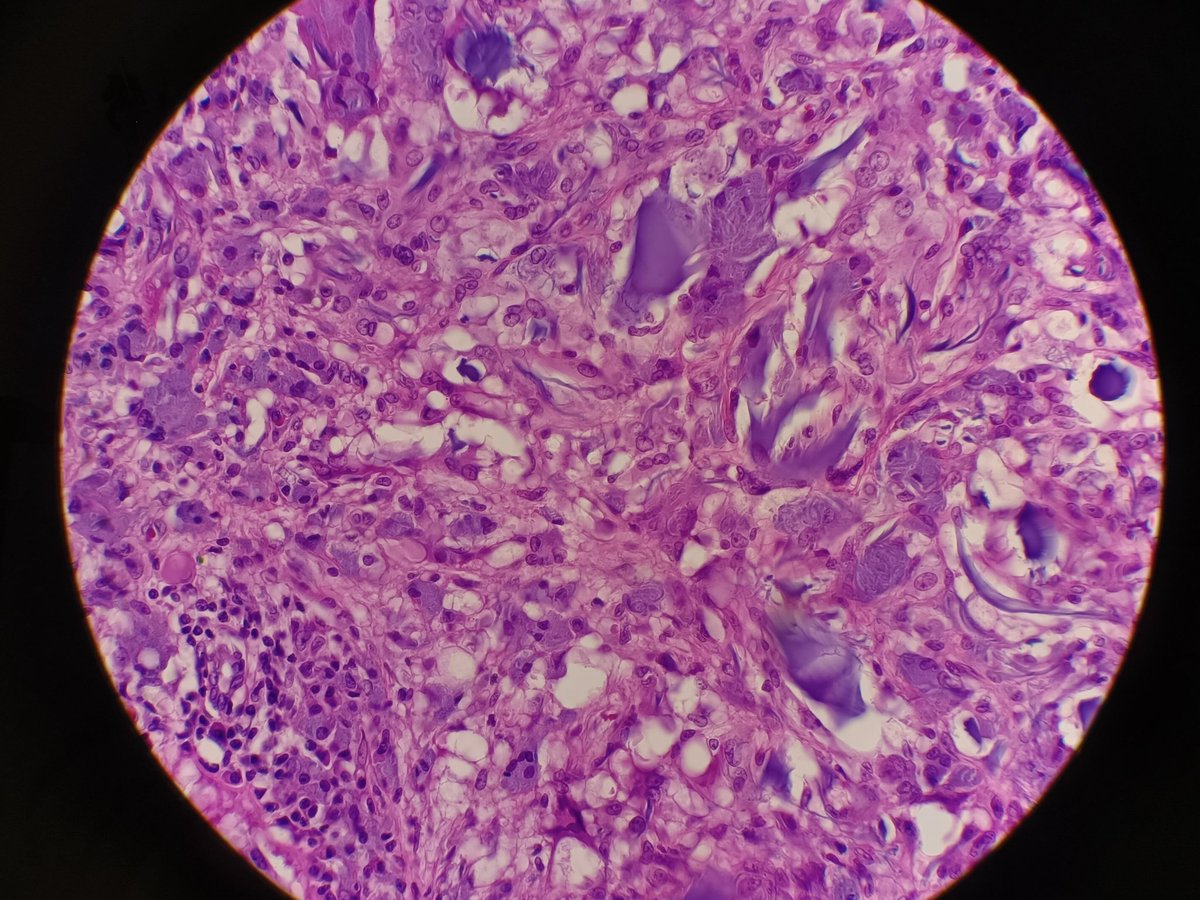Histiocita's tweet photo. Dear pathologists, have you ever seen this kind of blue material? This is from a toe (diabetic patient with severe vascular damaged with ulceration). #patht https://t.co/pXhXdxzEZ9