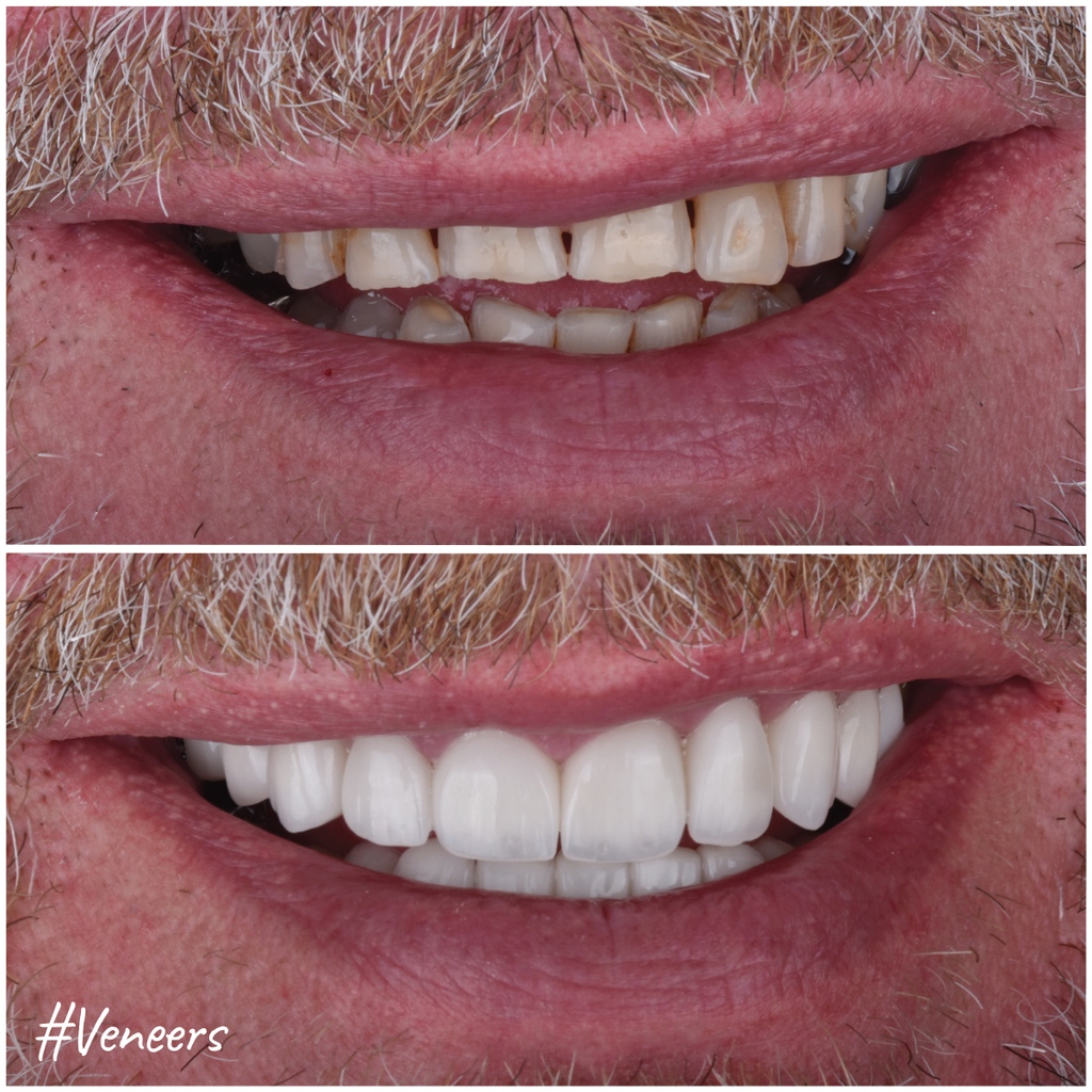 MicrisDental's tweet photo. #Bruxism. #Caries. Worn-down #toothstructure. Short teeth.

The patient lost his #confidence to smile due to these #dentalproblems.

But, thanks to our #dentalexpert, Dr. Nathalie Mama, and her adept work with #veneers &amp; #crowns, the patient gained a natural and #youthful smile. https://t.co/LAYOeoalHE