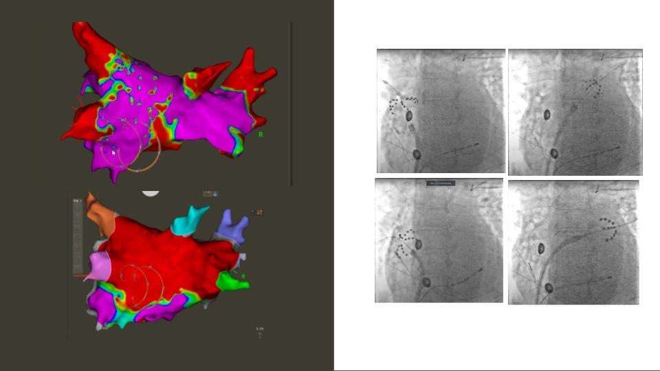 Excited and privileged to be first in Indiana to use #Farawave ablation for the #Advantage trial. Great individual results, await long term trial data. Thank you @BSCCardiology @StVHeartCenter StV CVRI for the support! @EPrystowskyonEP @JeffOlson6 @BradClarkEP