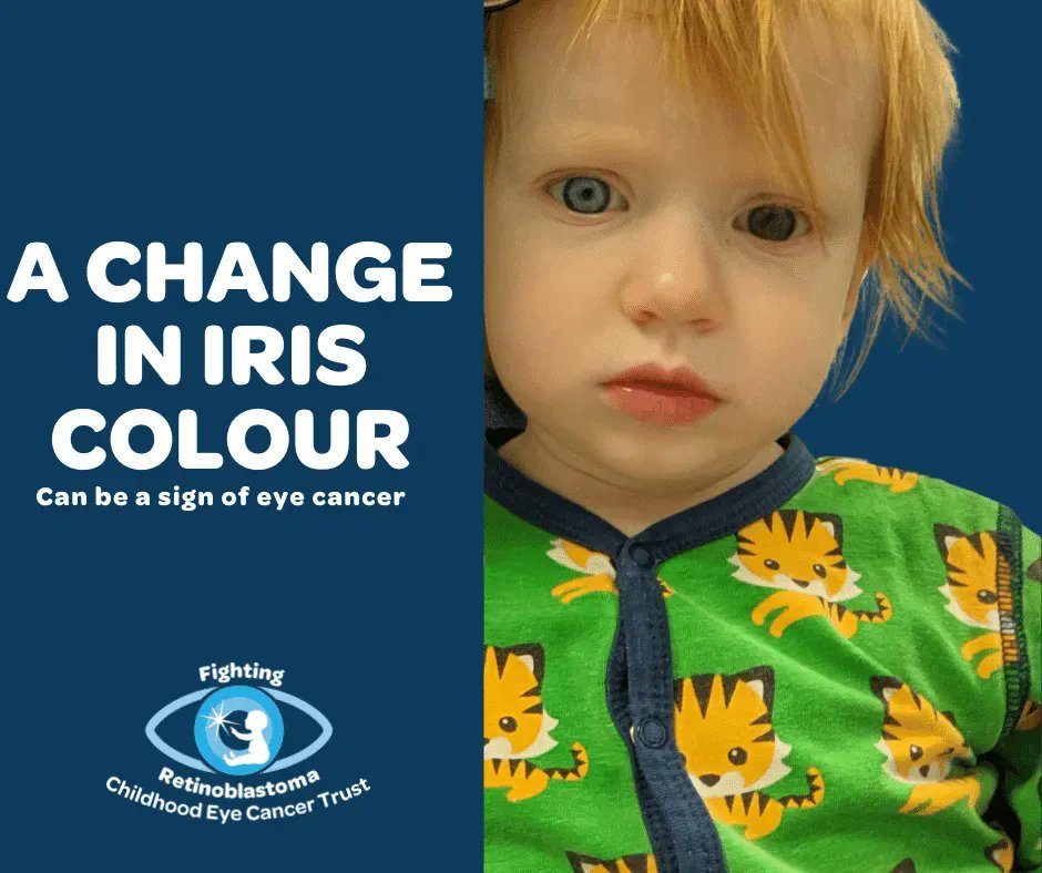 The iris – the coloured part of the eye – can change colour in one eye, sometimes only in one area, when a child has retinoblastoma (childhood eye cancer). If you notice a change in the colour of your baby or child’s iris, let a healthcare professional know #RbWeek