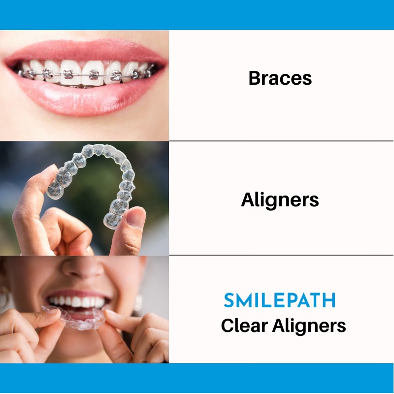 Ease your journey to a beautiful smile with us.
Visit the link bit.ly/3kd8XWl for starting the smile journey!
.
.
#Smilepath #clearaligners #invisiblealigners #beforeandafter #beforeafter #straightteeth #straightenteeth #straighterteeth #brightersmile