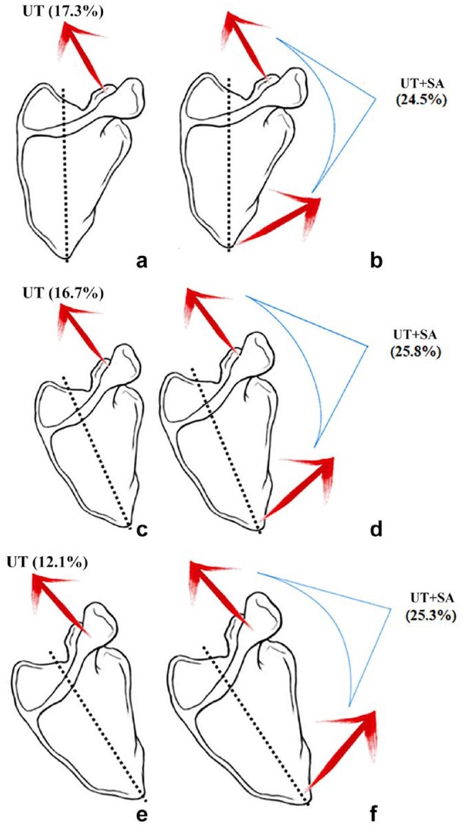 Sports_Health's tweet photo. Interested in understanding more about scapular kinematics during shoulder movement, specificially how position impacts muscle contribution? @aaspt_apta #PhysicalTherapy #Shoulder #ShoulderMuscle #ScapularDyskinesis https://t.co/poEitlo9wu https://t.co/jcjjfjI7h7