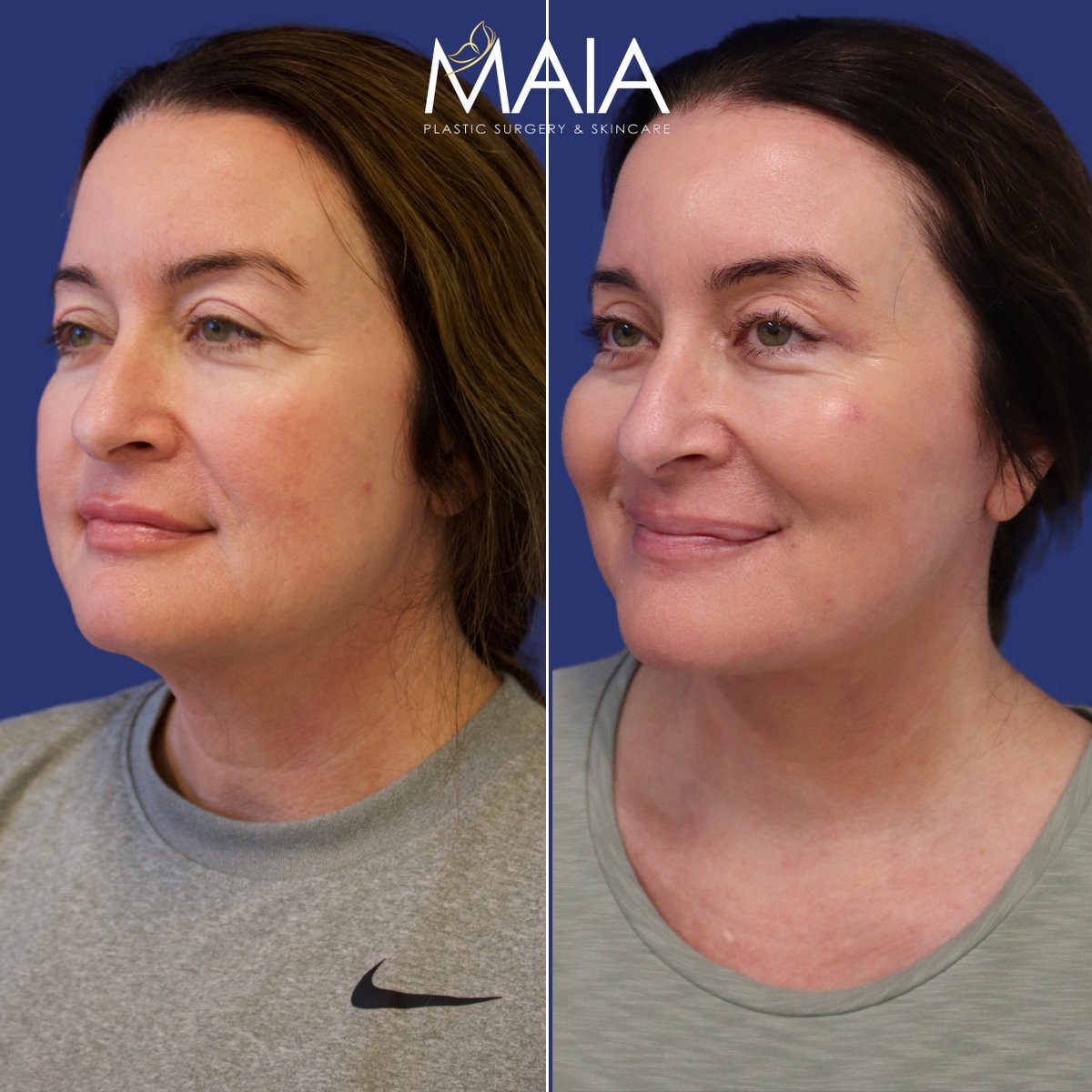 drmuniquemaia's tweet photo. #youglowgirl - 49 yo before and after a #facelift, #necklift, #uppereyelidlift, #facialfatgrafting, and a #TCApeel. She loves her results! 
__________________________________
#plasticsurgery #plasticsurgeryresults https://t.co/opJhoXWFQ1