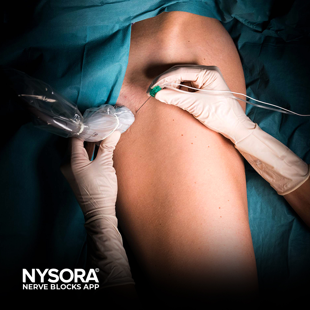 NYSORA's tweet photo. A pocket-sized walkthrough of the #Obturator #NerveBlock is coming to the NYSORA Nerve Blocks!

The Nerve Blocks app is used by over 100,000 #medical professionals globally. Test drive some of the lessons for free: https://t.co/95hElKpbha

#anesthesia https://t.co/rRDYgYz7vV