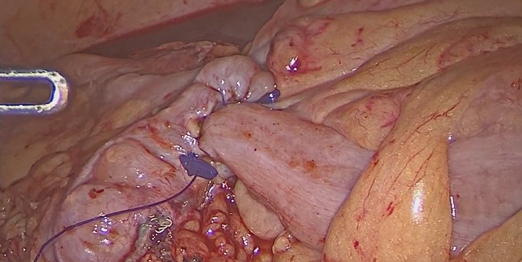 🚨NEW VIDEO ALERT: Colorectal surgery
🔗 bit.ly/3We0HYd
“Organ-sparing with complete vein and artery preservation (CoVAP) in left colon cancer”

#websurg #ircad #surgery #minimallyinvasivesurgery #colorectalsurgery