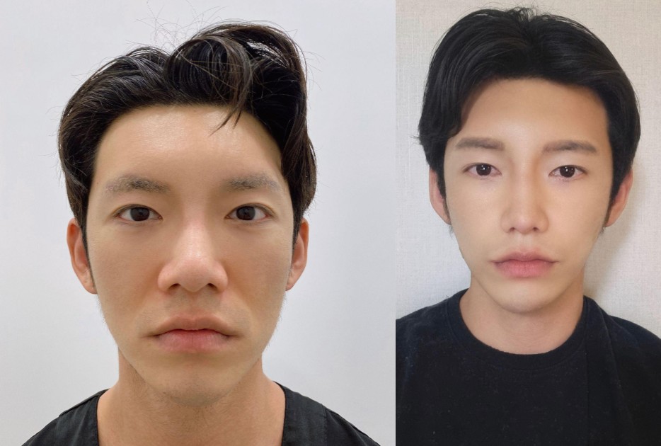 SoonplusJ's tweet photo. 【SOONPLUS整形外科】症例写真
手術内容： #鼻再手術 #貴族手術
お気軽にLINEでお問い合わせください。 
美しさの完成はSOON PLUS整形外科！ 
公式💚LINE@776lgakf  
#韓国美容整形 #SOONPLUS整形外科 #スーンプラス #韓国整形 #韓国美容整形 #韓国旅行 #整形外科 https://t.co/g5zU2kqcyH