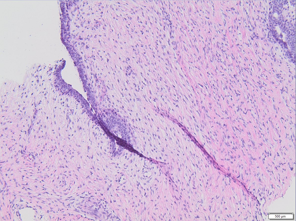 Fibroepithelial lesion in breast of 42/F that has been there but doubled it's size in few months. What wording should be used on core biopsy? Poll below. Comments are welcome #breastpath