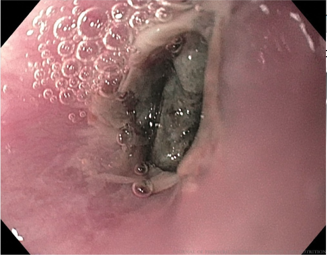 JPGNonline's tweet image. 18 mo boy with an esophageal button battery impaction (in situ 26hr).  Ultimately, MRA showed moderate mediastinitis and inflammation adjacent to the aorta.  

How do you follow up with imaging?

Answer and learn more 👉 bit.ly/3C9ldzo

@‌alex_s_hudson

#imageofthemonth