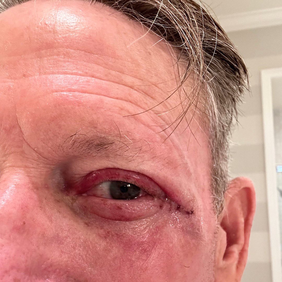 As some of you may have seen, my eye is currently healing. Last week I had Mohs surgery to treat skin cancer near my eye. 

May is #skincancerawareness month. 

Make sure you protect yourself when out in the sun &amp; get an annual skin check!