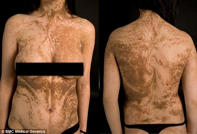 hibbary's tweet photo. The tired is ongoing. I have nothing new. Instead, enjoy some Blaschko Lines. 

They're a result of embryonic development and humans have them. They are usually invisible but appear under UV or in certain skin diseases. 

I like the idea of having secret stripes. https://t.co/xk80T60NYB