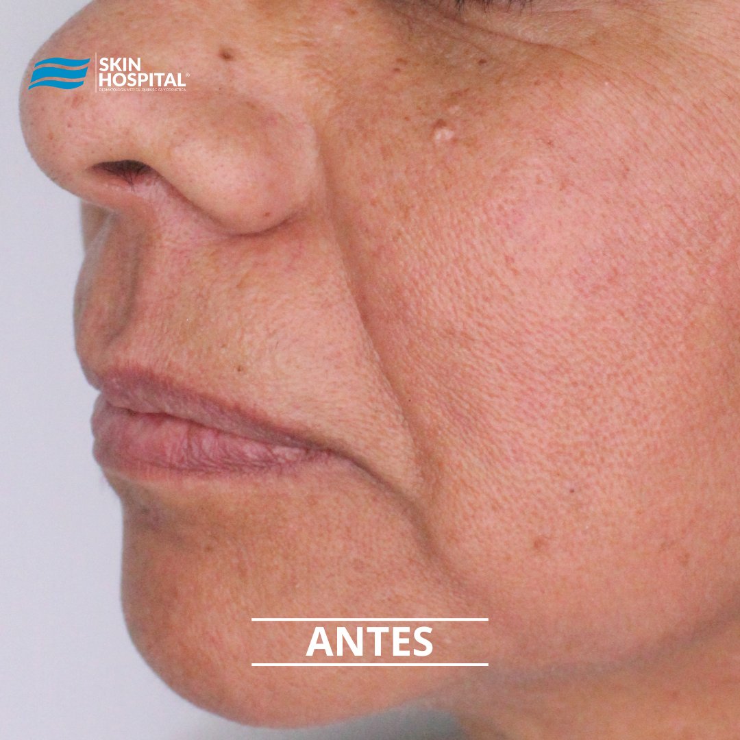 SkinHospital_mx's tweet photo. RELLENO FACIAL

Atrévete a lucir un #rostro más #joven y #hermoso, con los mejores tramientos de rejuvenecimiento que tenemos en #SKINHOSPITAL.

Acude a valoración para ver cúal es el que mejor se adapta a tus necesidades.

LOOK GOOD &amp; FEEL GOOD https://t.co/iqxCnoBG6i