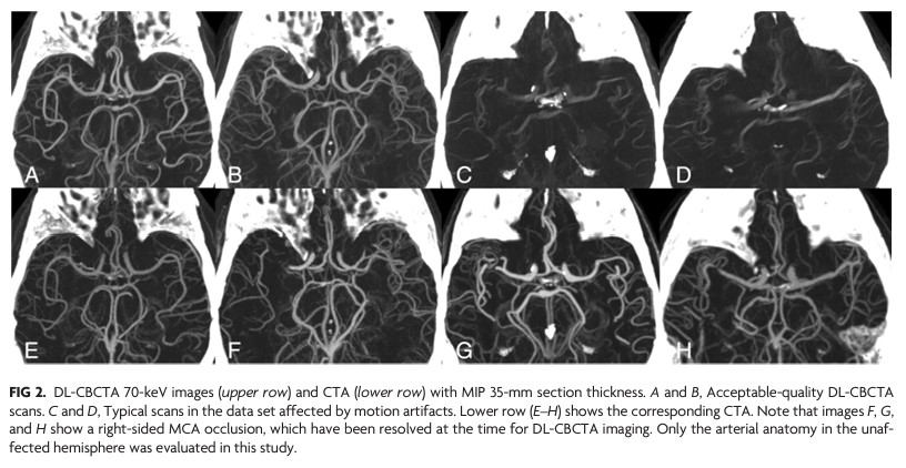 TheAJNR's tweet photo. "Dual-Layer Detector Cone-Beam CT Angiography for Stroke Assessment: First-in-Human Results (the Next Generation X-ray Imaging System Trial)" #Stroke #ConeBeamCT #OpenAccess #EditorsChoice | https://t.co/3LZsc0MChH https://t.co/cay5l96OCr